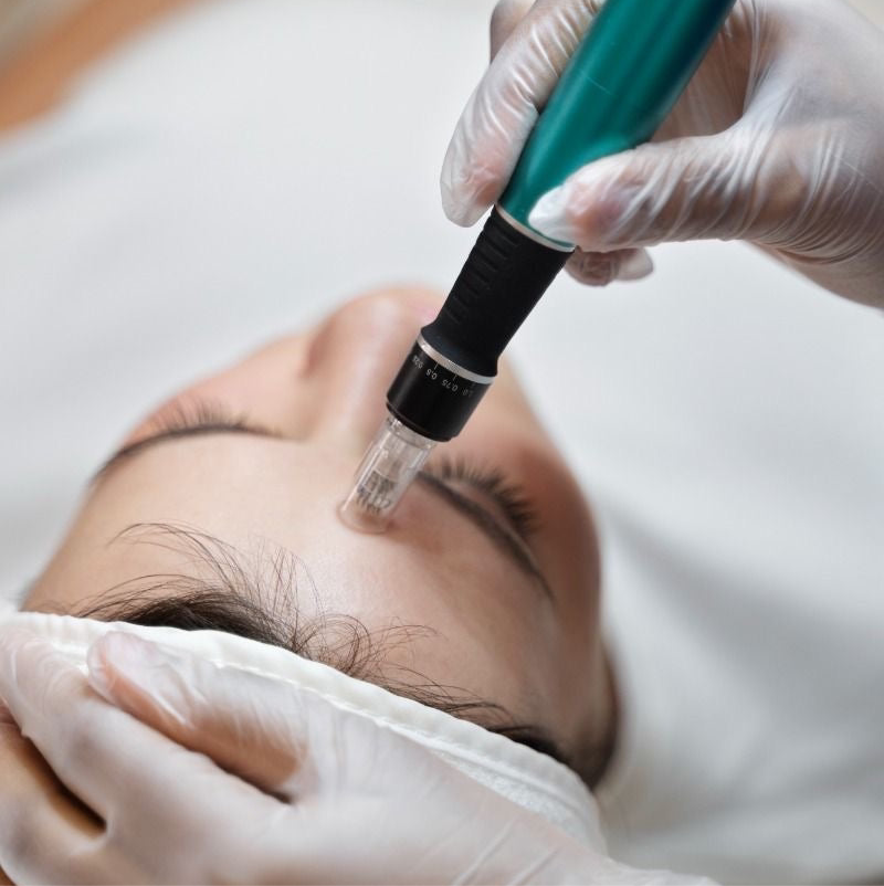 Course of 4 Microneedling - Face, Neck & Decolletage