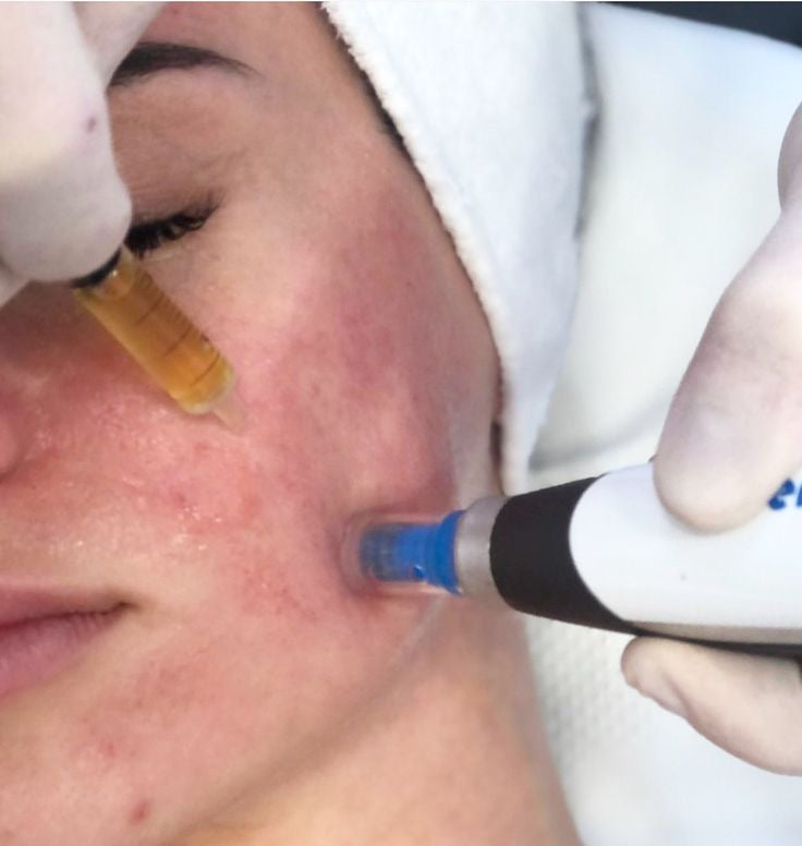 Bio Needling - Courses