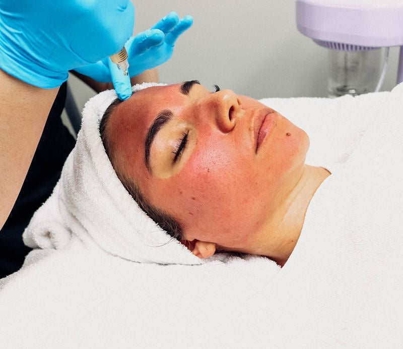 Vampire Facial
